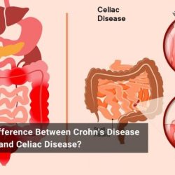 Colitis ulcerative crohn